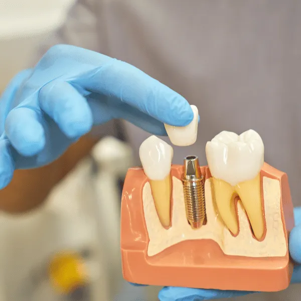 Implant Dental Treatment