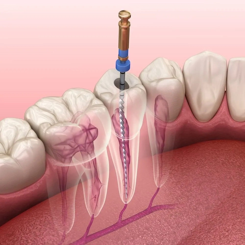 Endodontics / Root Canal Treatment